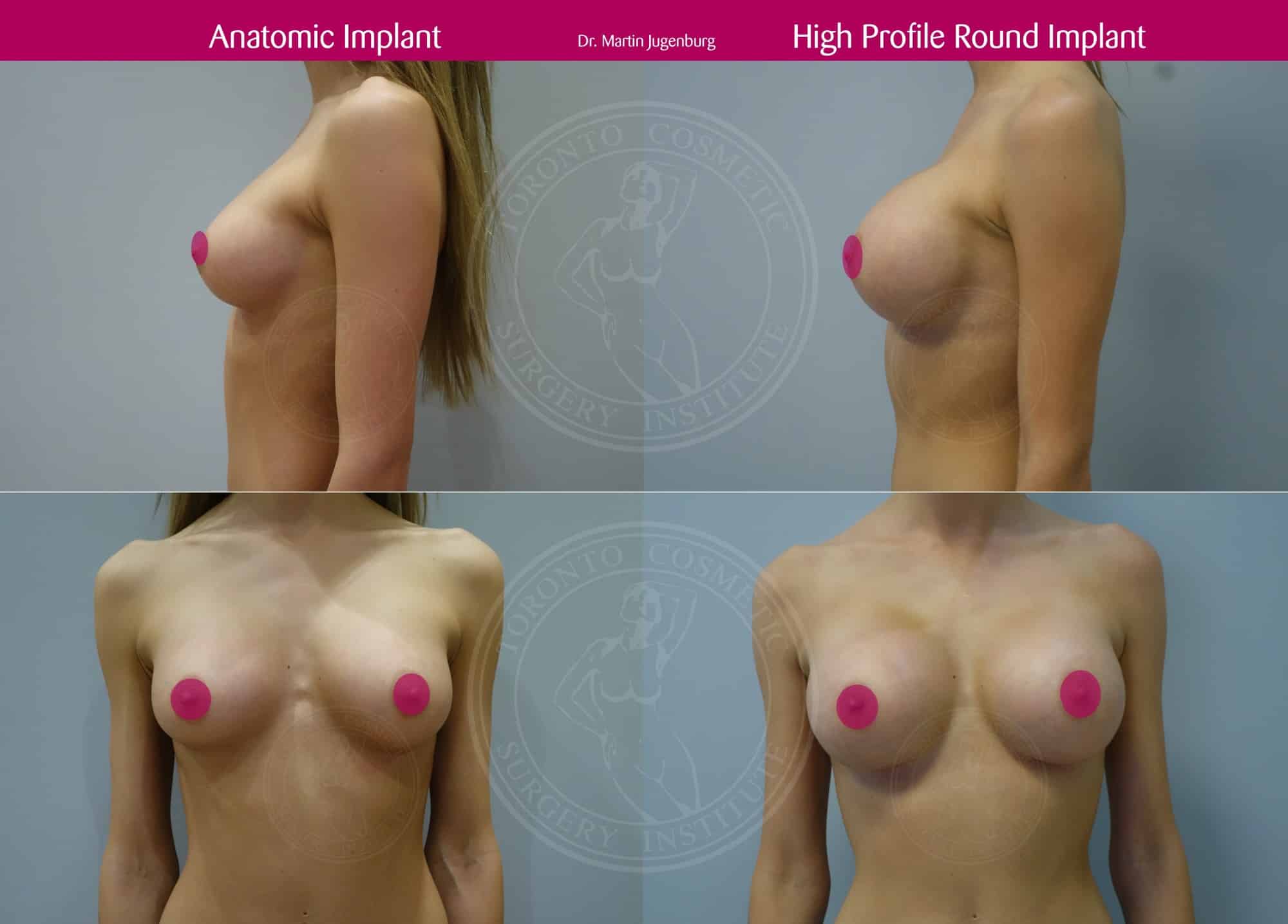 xcomposite BBA Anatomic vs Round Implant FB