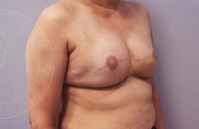 Breast Reconstruction Gallery