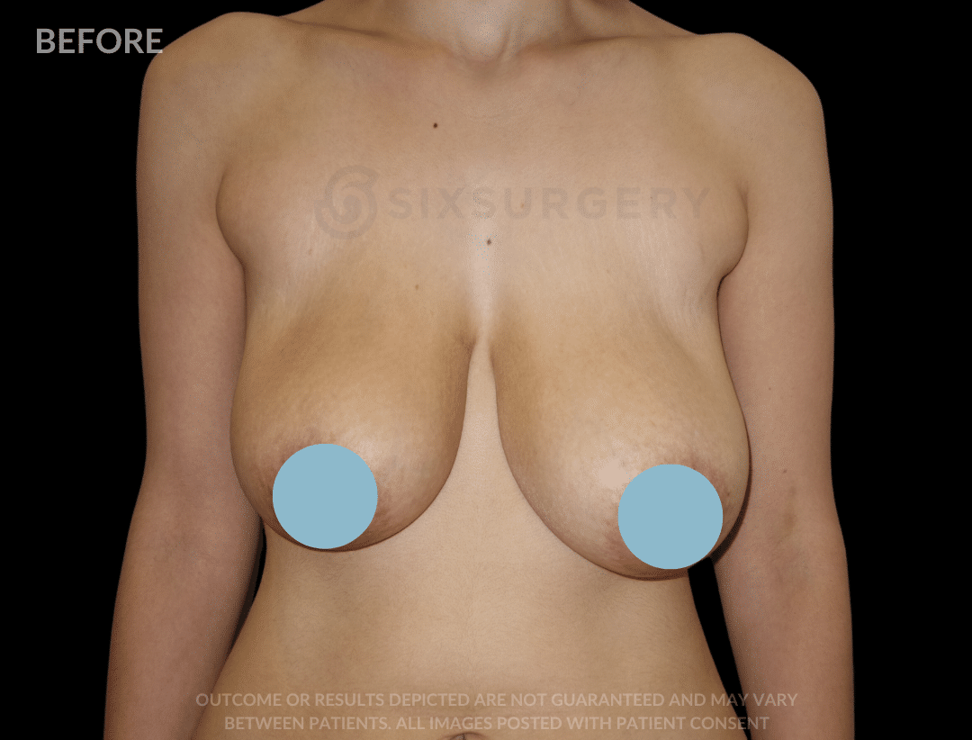 before and after breast lift six surgery toronto