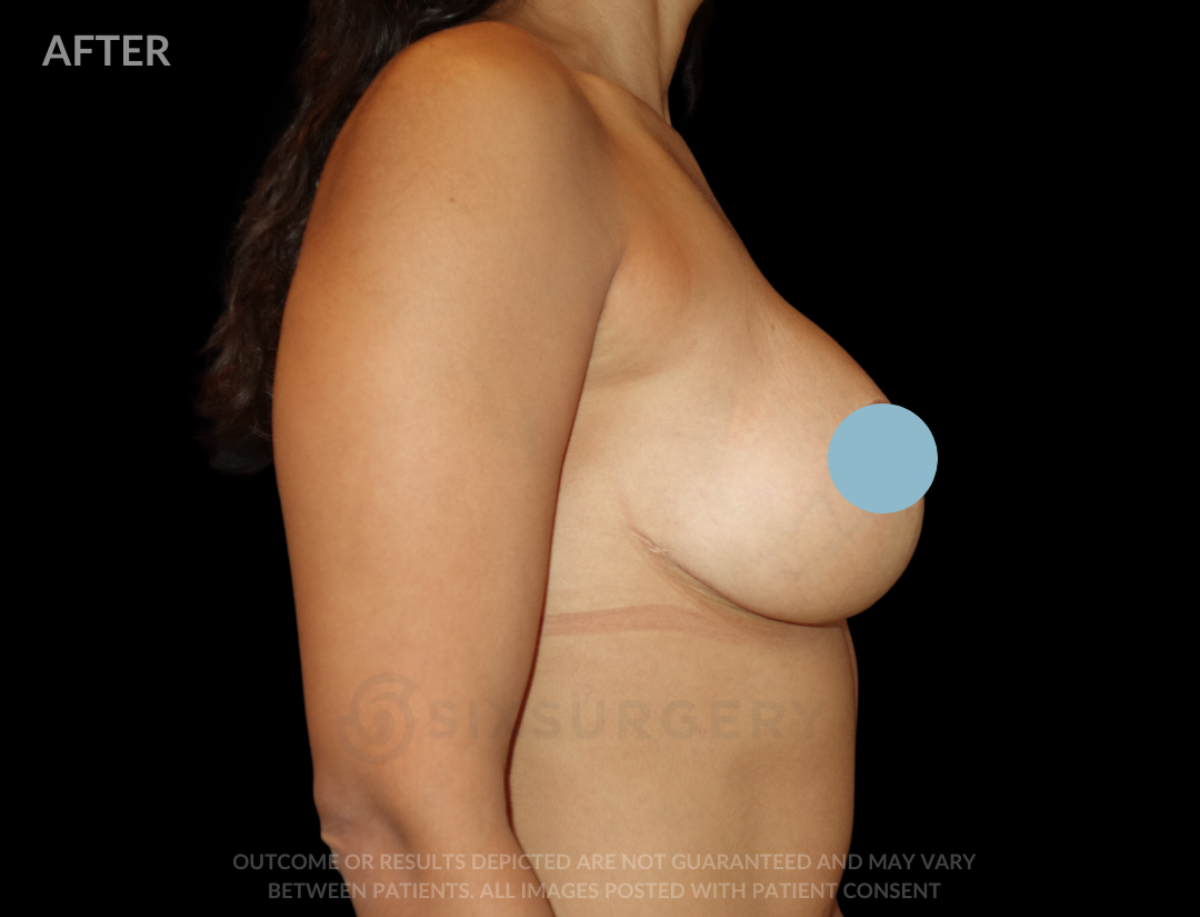 before and after breast lift six surgery toronto