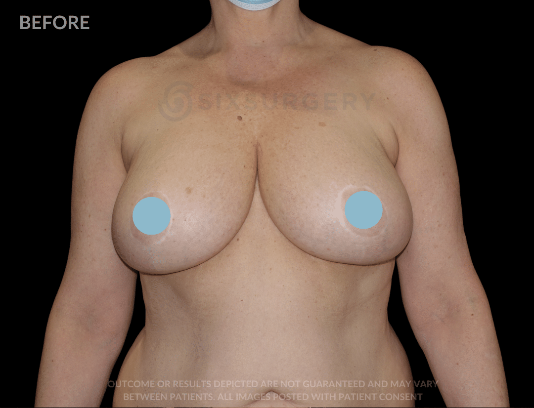 breast reduction before and after six surgery toronto