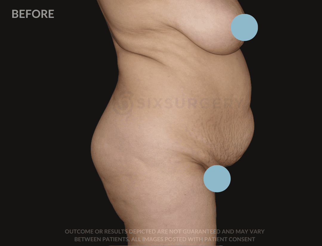 six surgery before and after breast reduction tummy tuck mommy makeover
