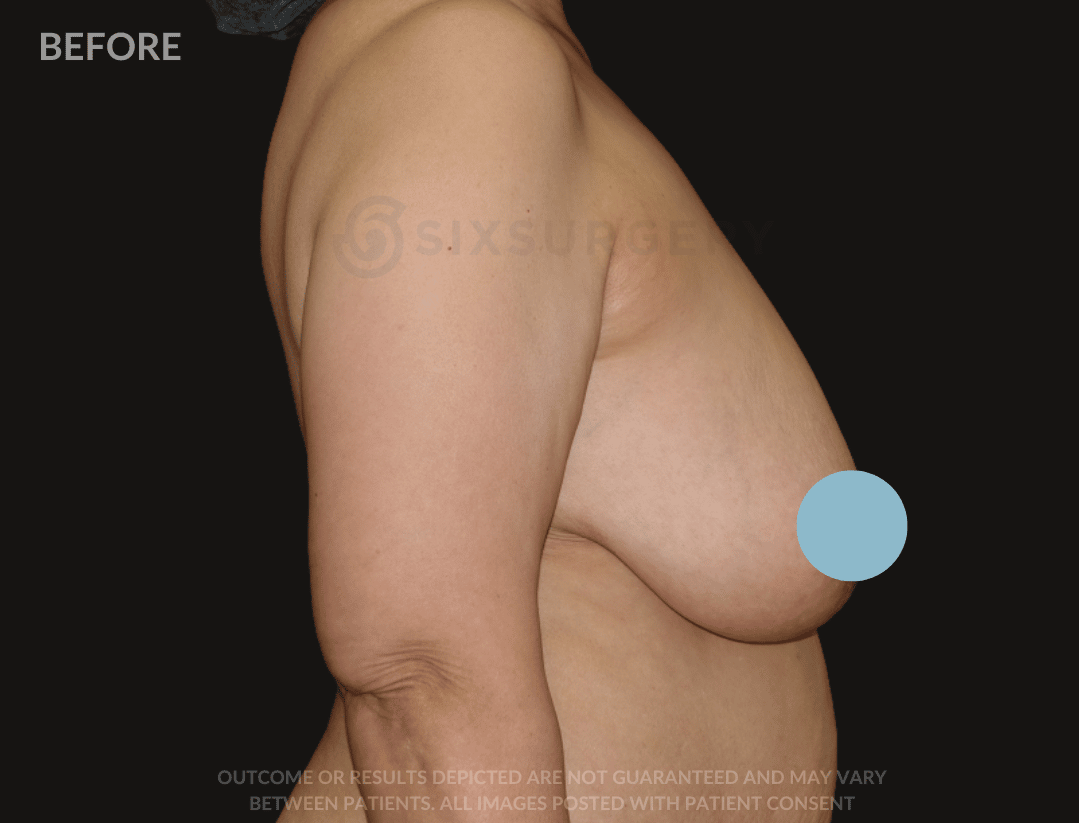 six surgery before and after breast reduction