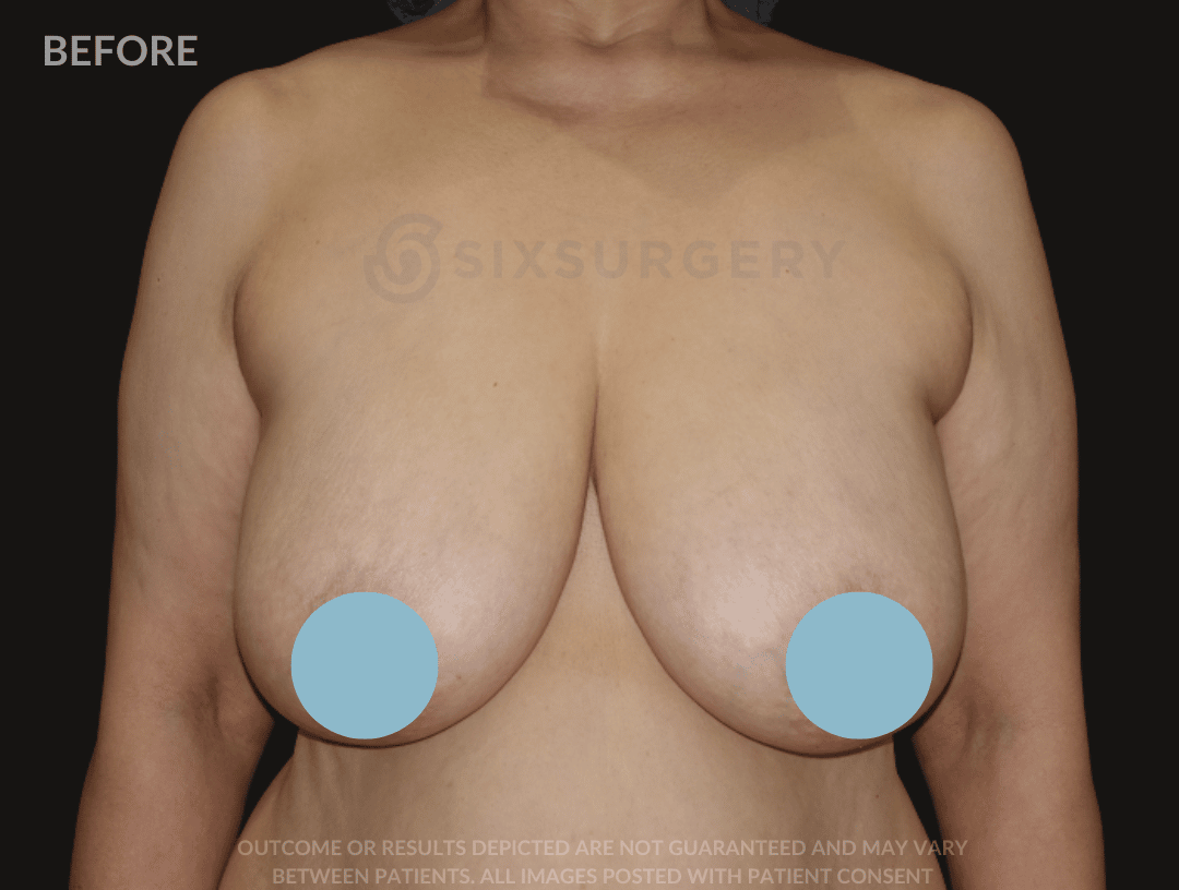 six surgery before and after breast reduction