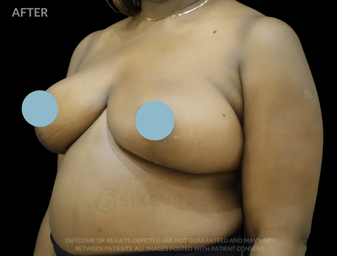 before and after breast reduction six surgery toronto