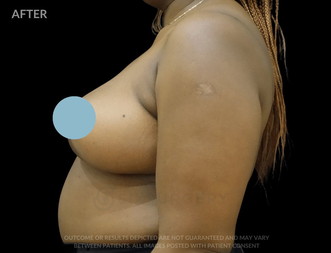 before and after breast reduction six surgery toronto