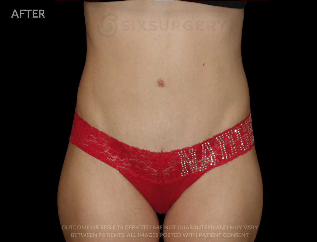 before and after tummy tuck - six surgery - TCSI - toronto