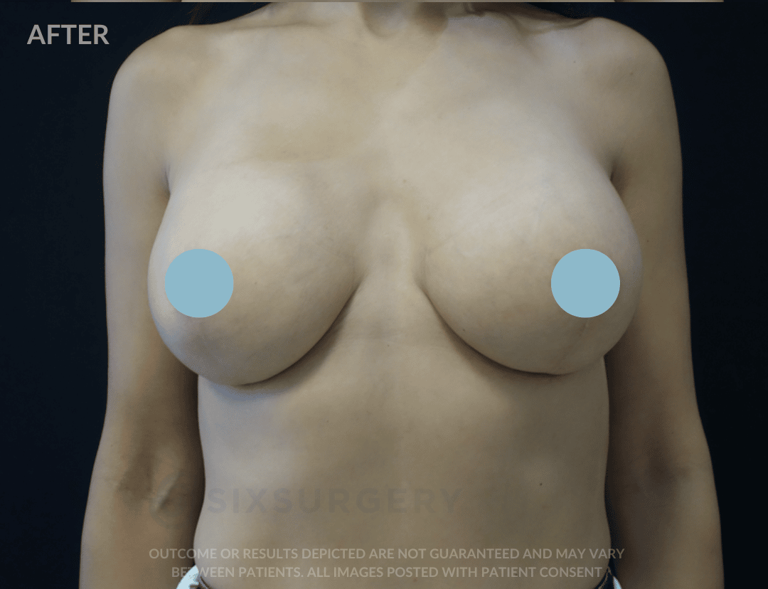 sixsurgery breast lift and augmentation before and after