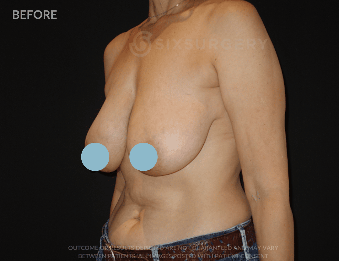 sixsurgery breast reduction before and after