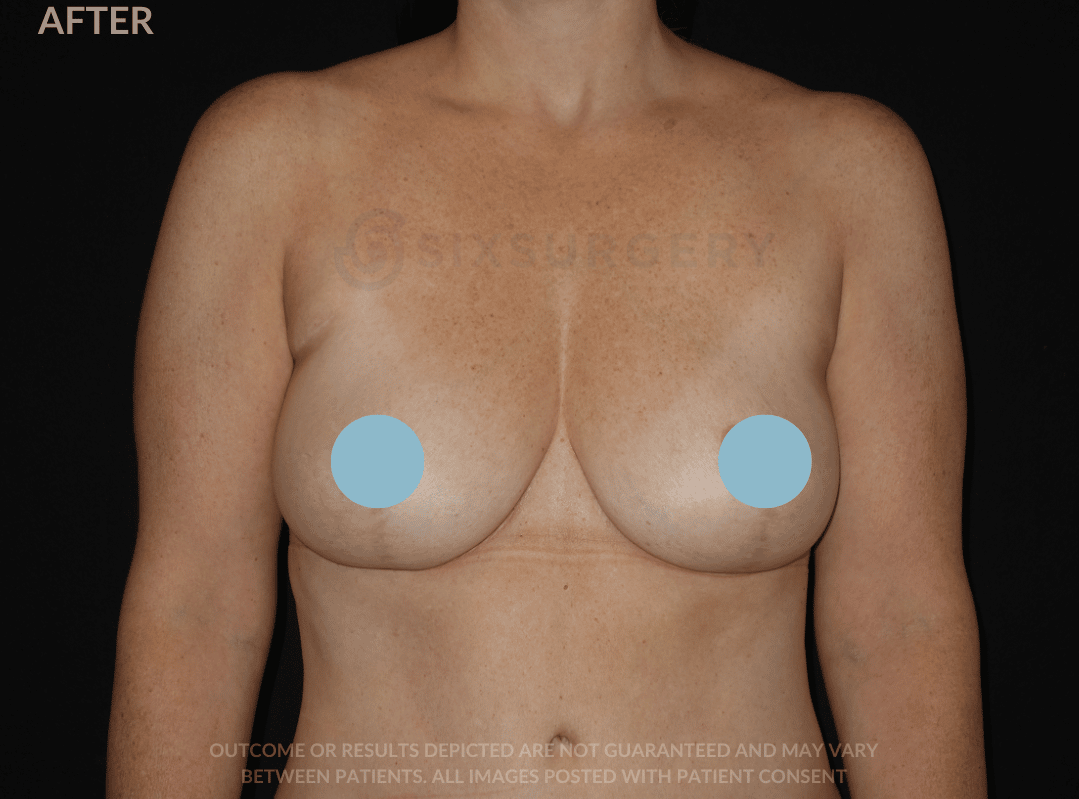 sixsurgery breast reduction before and after