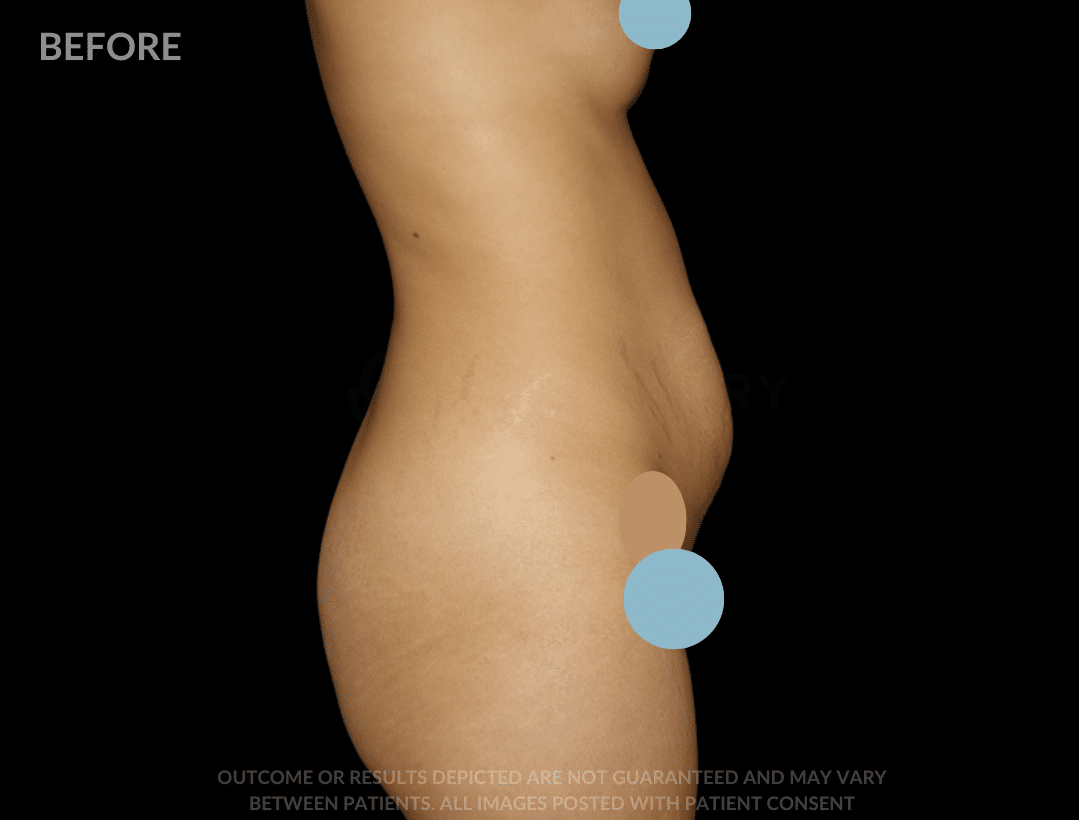 sixsurgery tummy tuck before and after