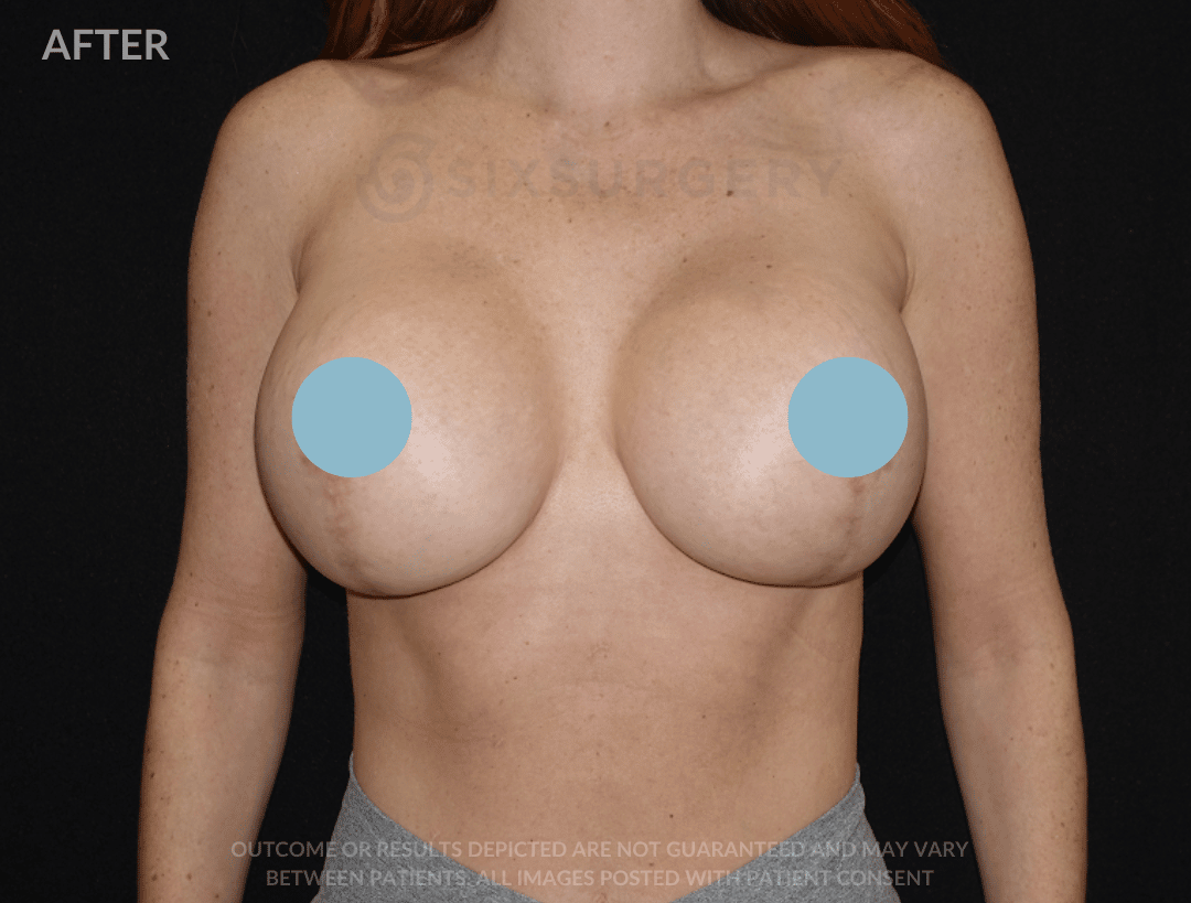 sixsurgery breast lift and breast augmentation before and after