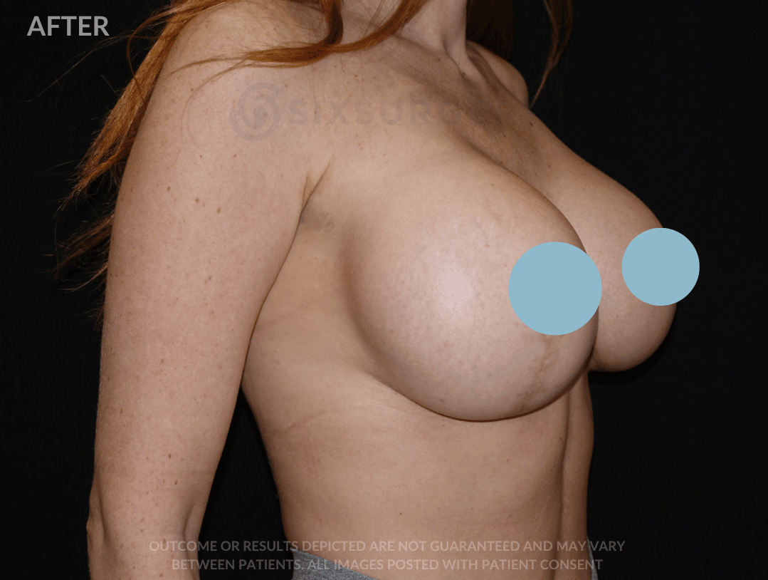 sixsurgery breast lift and breast augmentation before and after