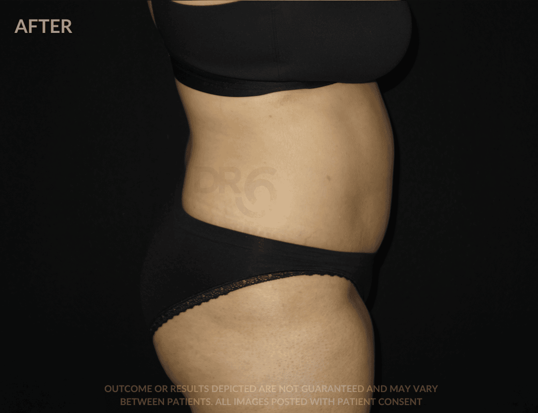 sixsurgery tummy tuck (abdominoplasty) before and after