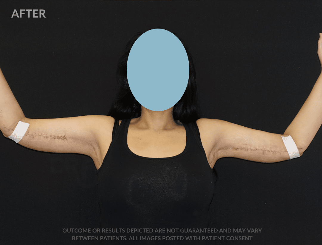 sixsurgery armlift before and after