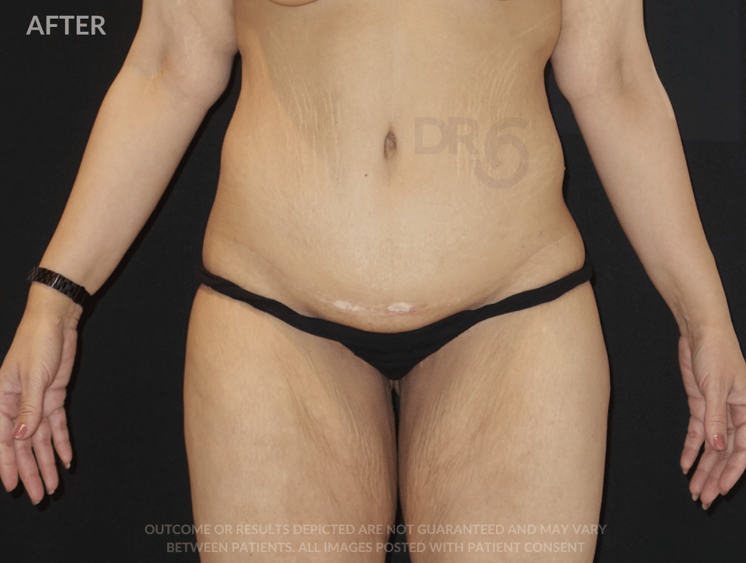 sixsurgery body lift before and after