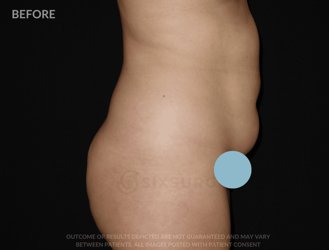 sixsurgery liposuction before and after