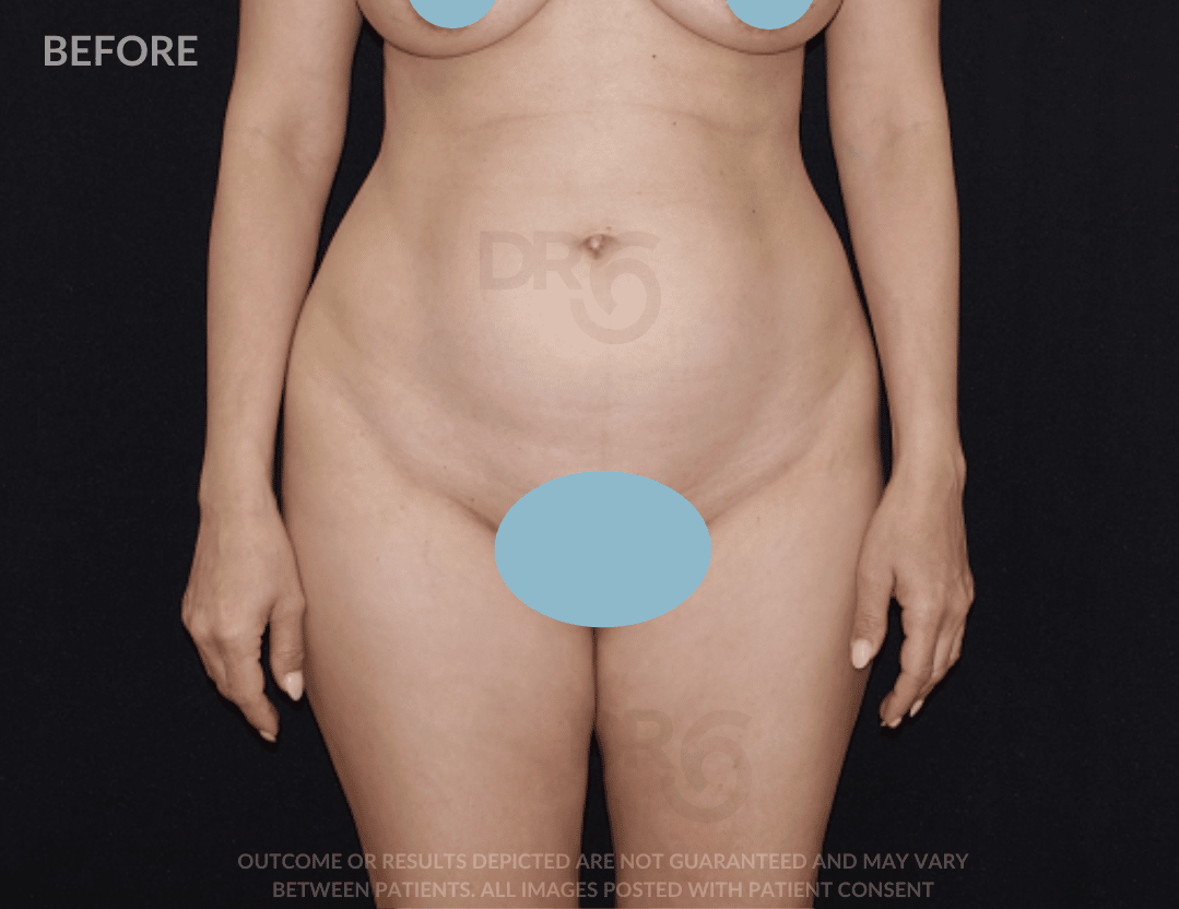 sixsurgery Liposuction before and after