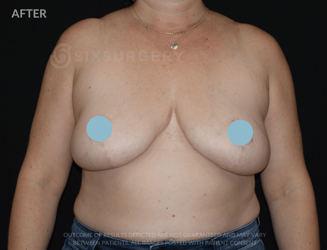 Breast Reduction Before and after