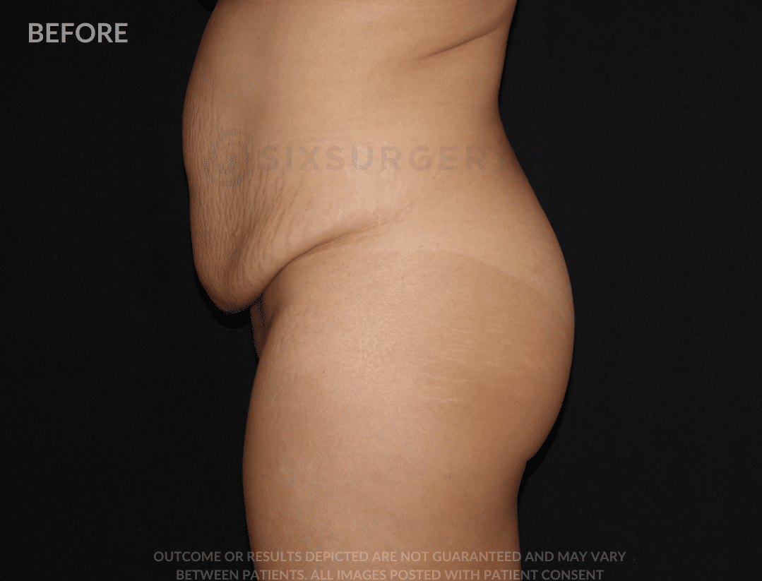 sixsurgery TUMMY TUCK liposuction before and after