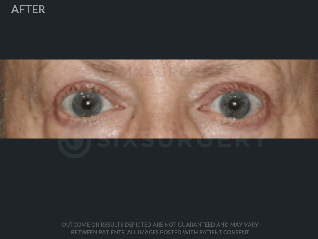 sixsurgery eyelids before and after