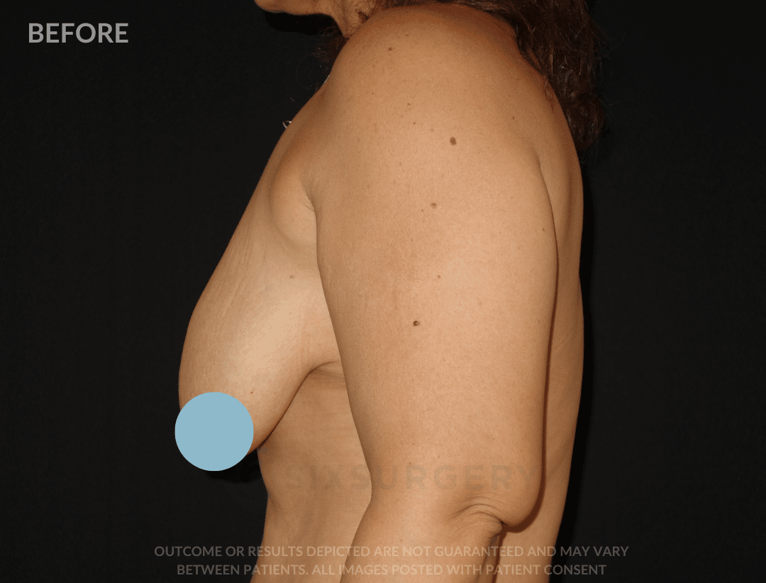 sixsurgery breast lift mastopexy before and after