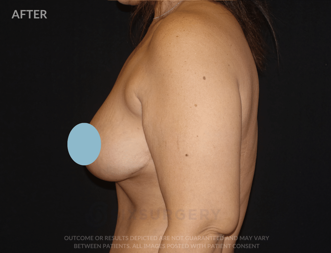sixsurgery breast lift mastopexy before and after