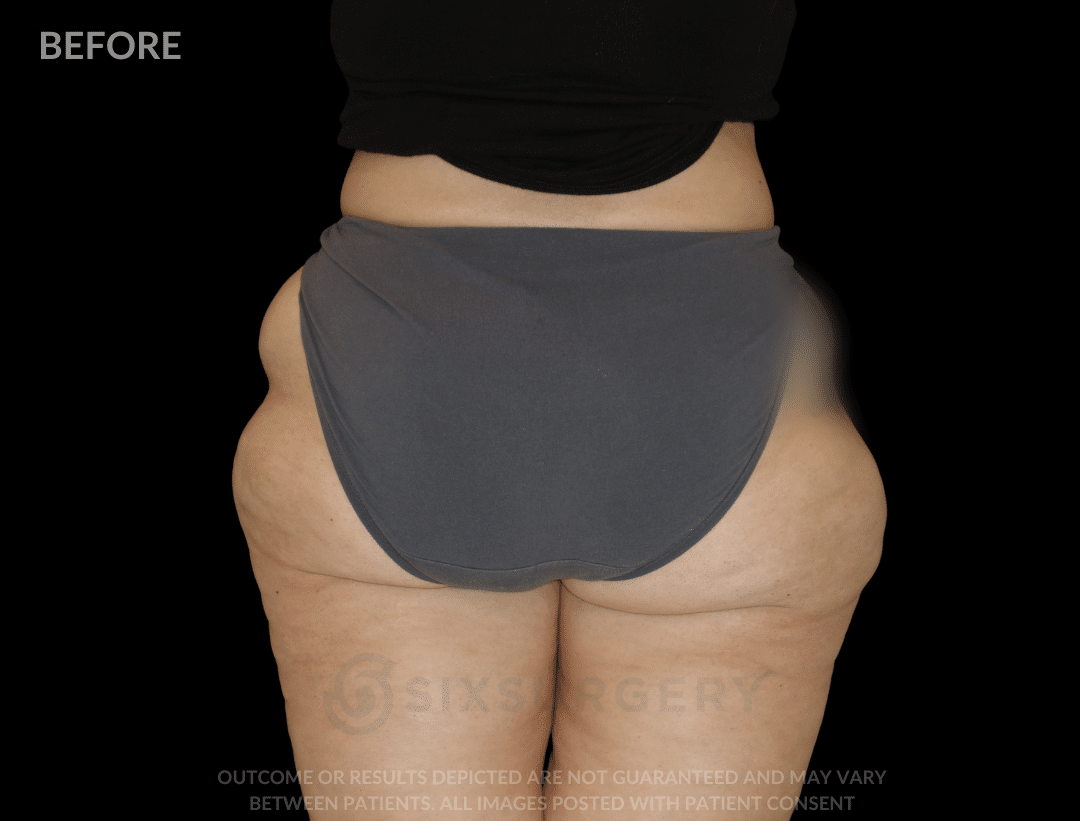 Before After six surgery liposuction lateral thigh Dr 6ix Toronto