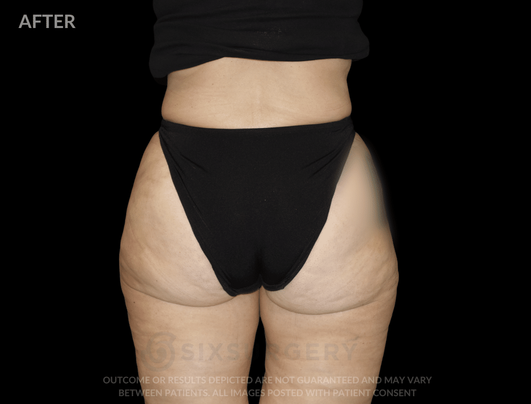 Before After six surgery liposuction lateral thigh Dr 6ix Toronto