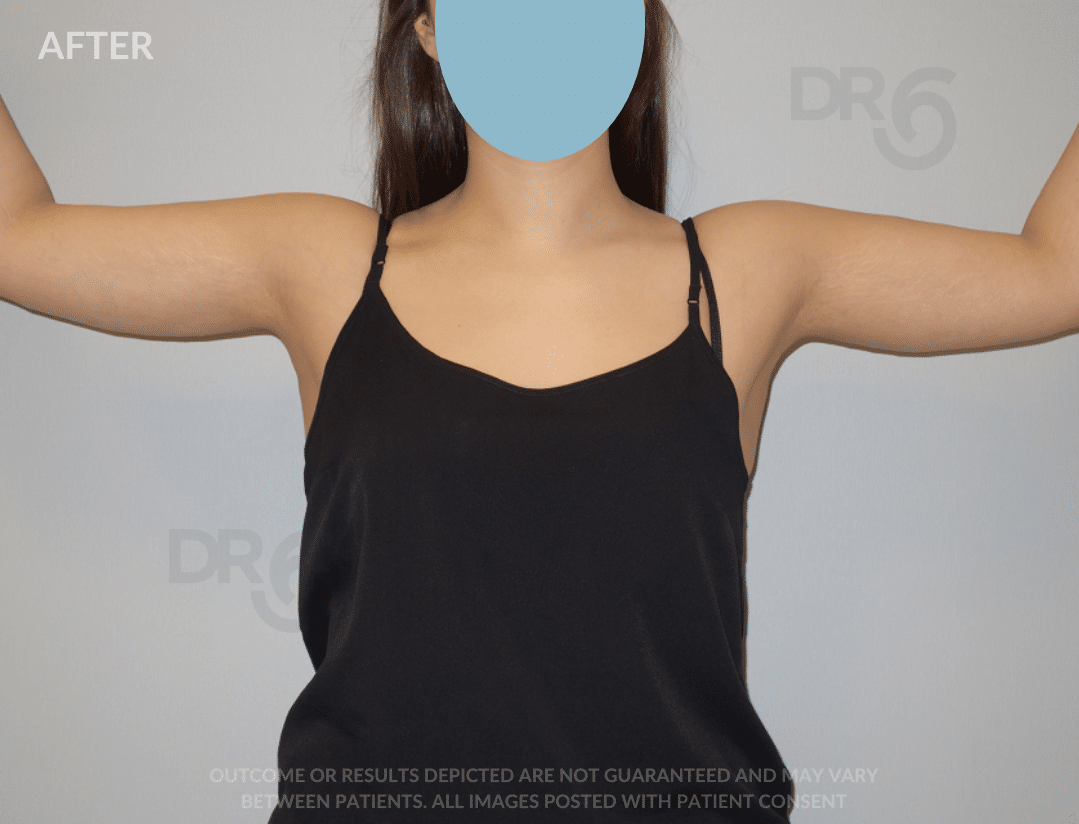 sixsurgery armlift before and after