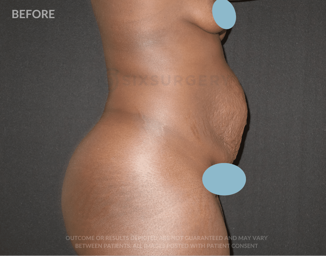 sixsurgery TUMMY TUCK liposuction before and after