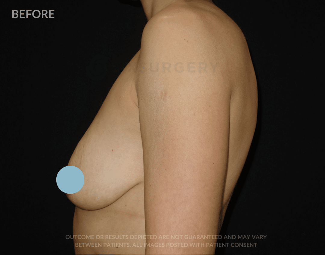 sixsurgery breast lift and augmentation before and after