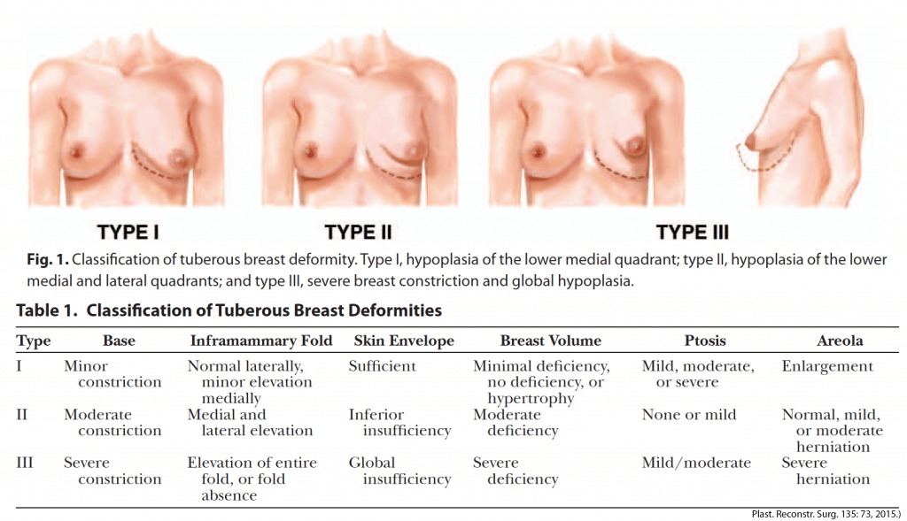 Tuberous breast deformity classification