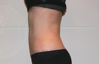 sixsurgery toronto tummy tuck abdominoplasty before and after