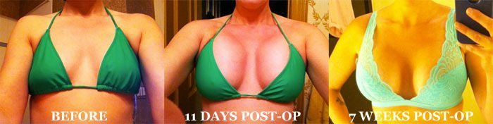 before post breast augmentation