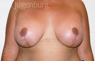sixsurgery toronto breast lift mastopexy before and after