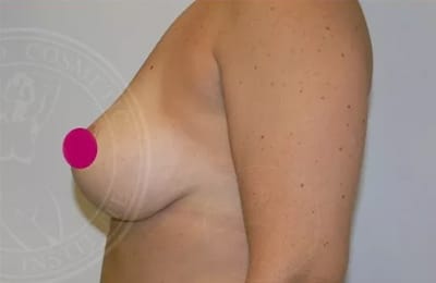 Dr Martin Jugenburg toronto breast lift mastopexy with implants before and after