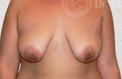 sixsurgery toronto breast lift mastopexy before and after