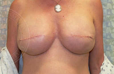 Breast Reconstruction Gallery