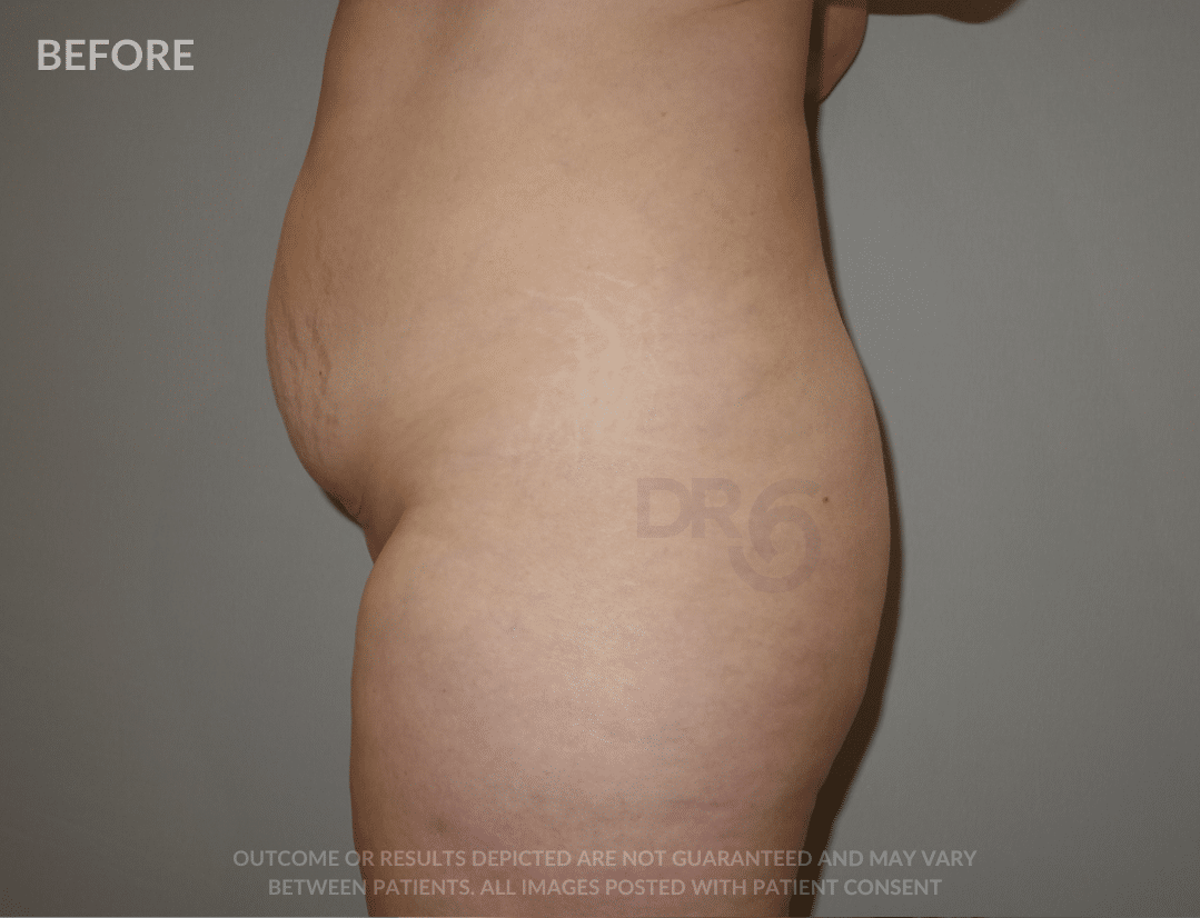 sixsurgery tummy tuck (abdominoplasty) and liposuction