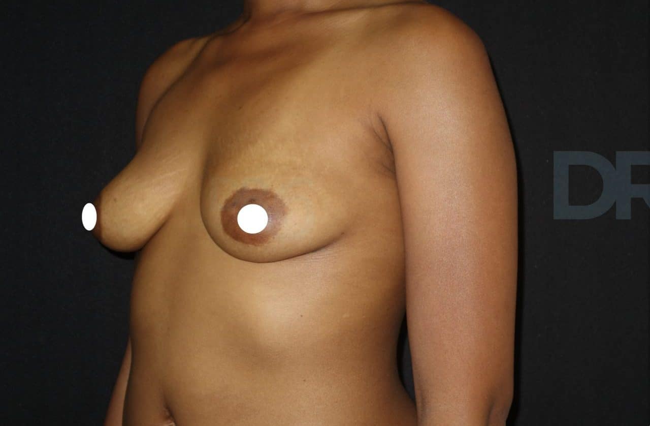sixsurgery toronto breast augmentation implants before and after