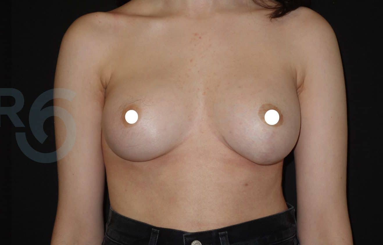 sixsurgery toronto breast augmentation implants before and after