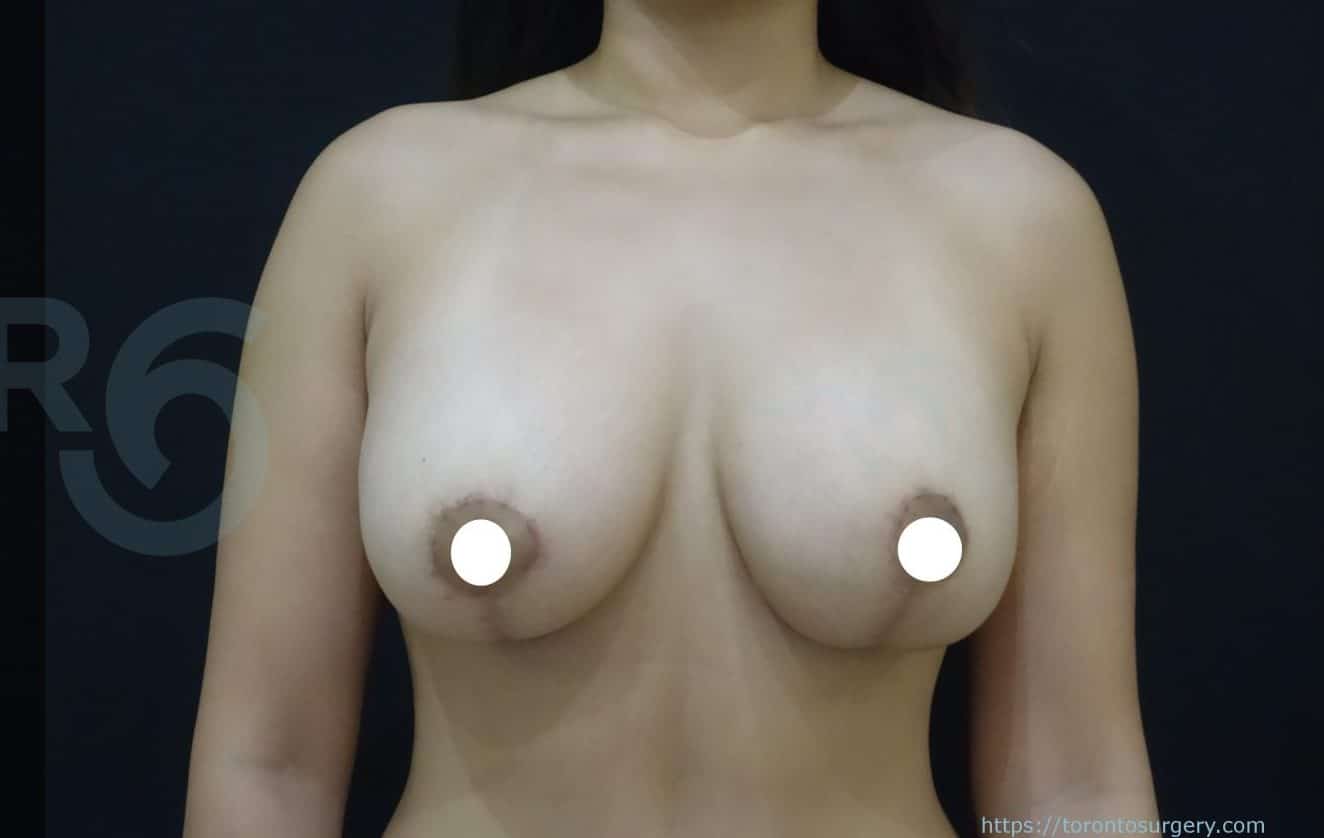 sixsurgery toronto breast lift mastopexy with implants before and after