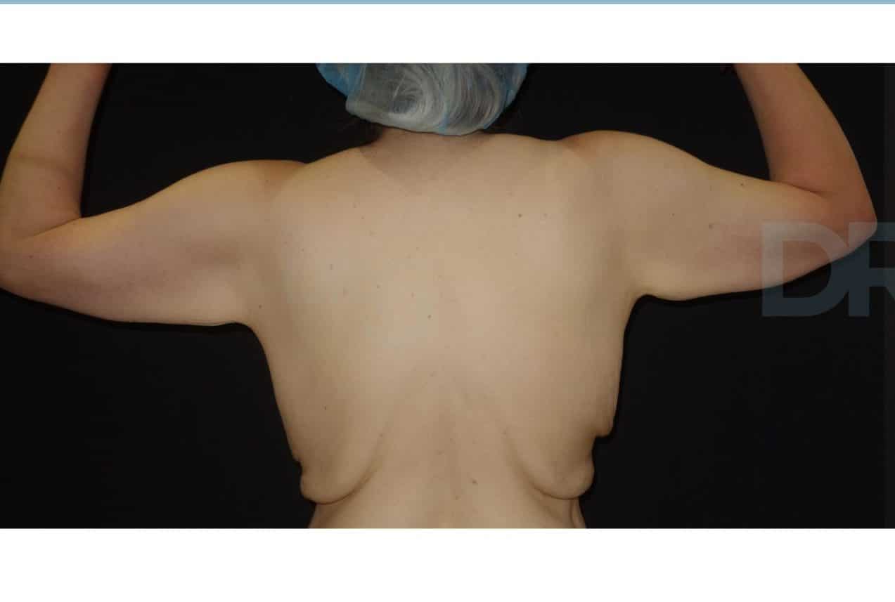 sixsurgery toronto arm lift brachioplasty before and after