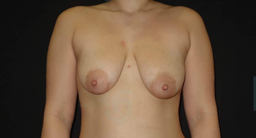 sixsurgery toronto breast lift mastopexy with implants abdominoplasty mommy makeover before and after