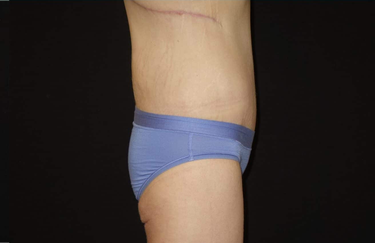 sixsurgery toronto body lift before and after