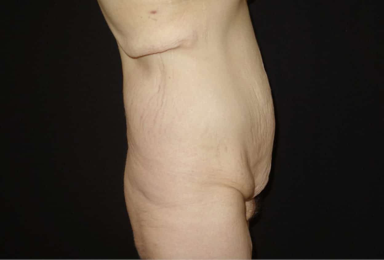 sixsurgery toronto body lift before and after