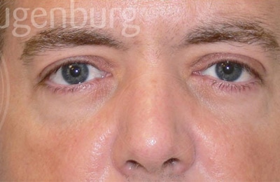 sixsurgery toronto eyelid upper lower blepharoplasty before and after