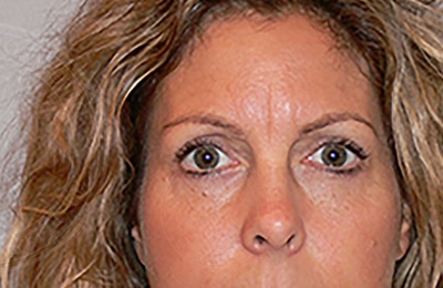 sixsurgery toronto eyelid upper lower blepharoplasty before and after