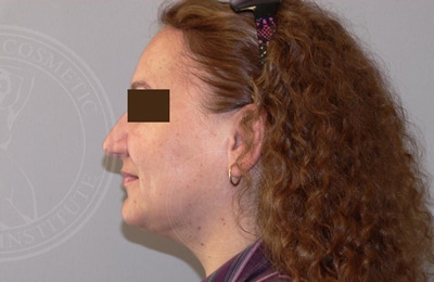 sixsurgery toronto liposuction chin before and after
